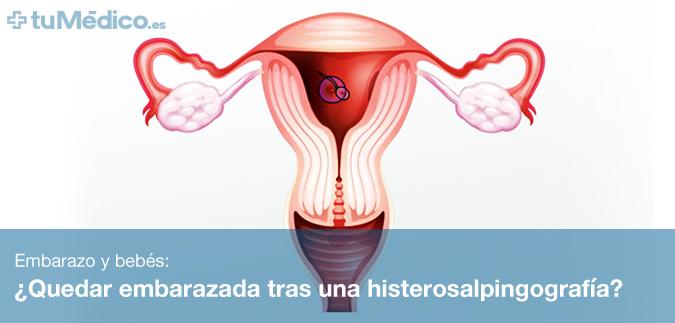 Quedar embarazada tras una histerosalpingografa?