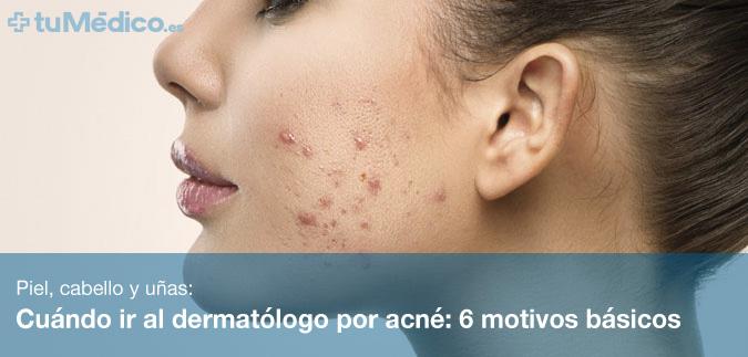 Cuándo ir al dermatólogo por acné: 6 motivos básicos