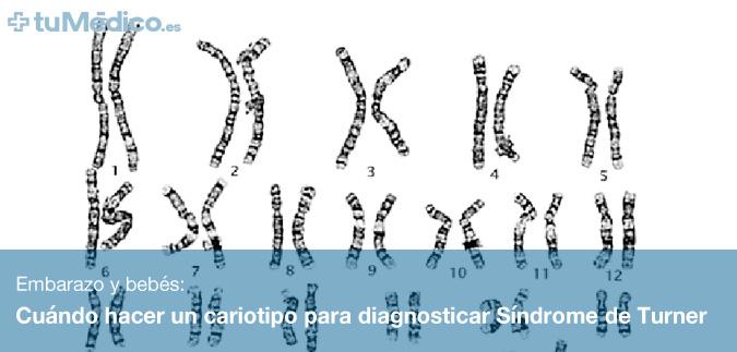 Cundo hacer un cariotipo para diagnosticar Sndrome de Turner