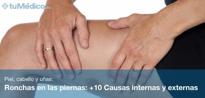 Ronchas en las piernas: +10 Causas internas y externas