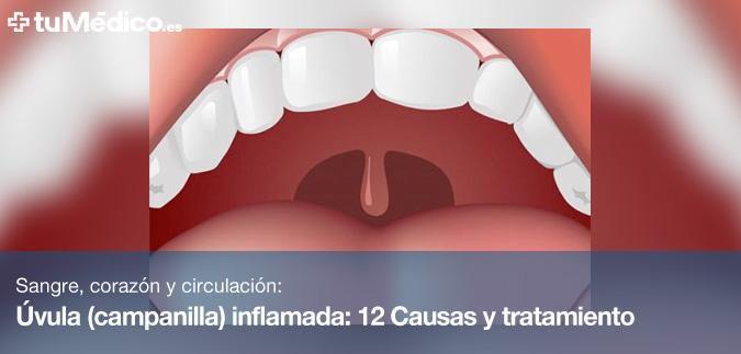 vula (campanilla) inflamada: 12 Causas y tratamiento