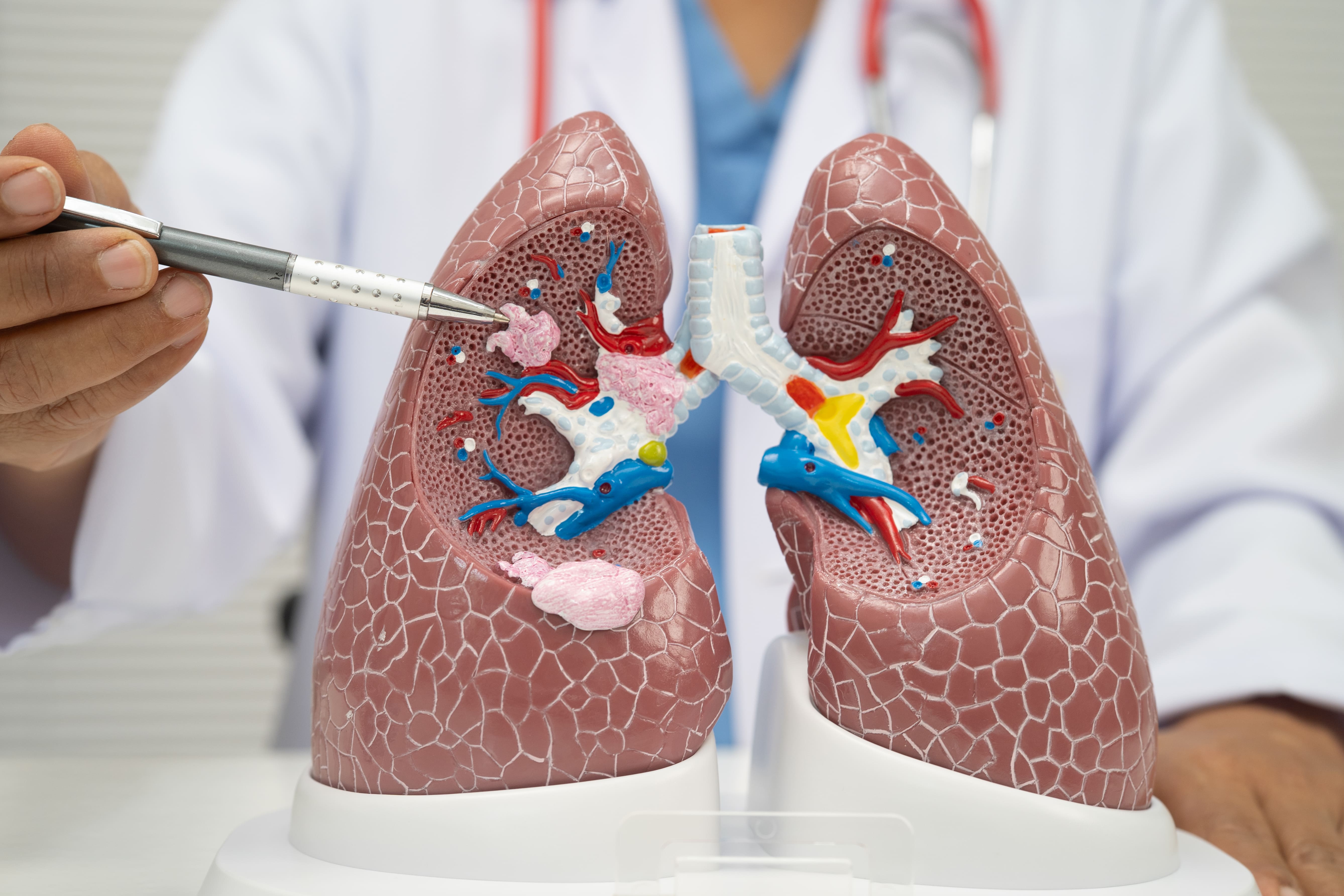 Qué es un edema pulmonar y por qué se acumula el líquido