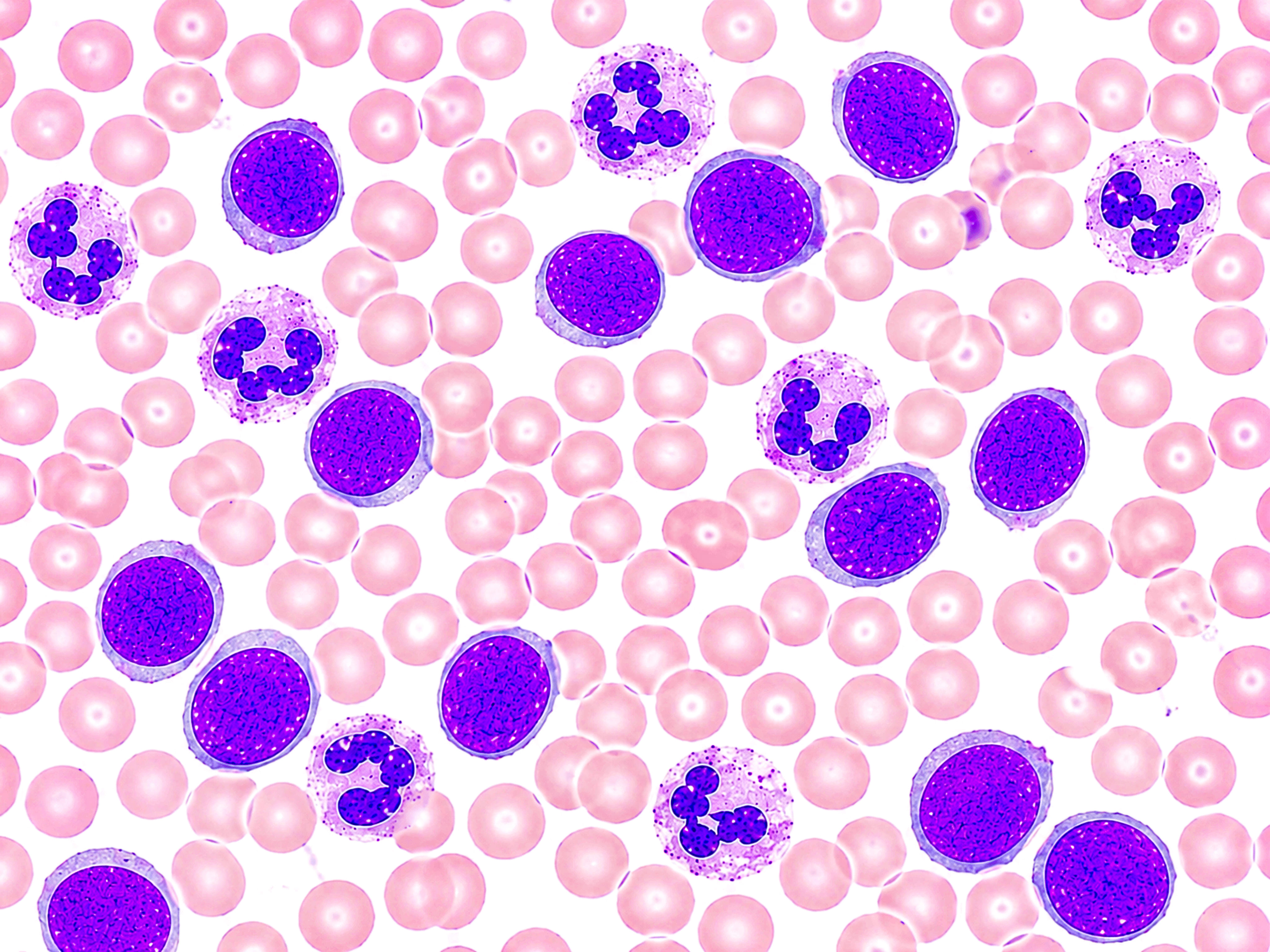 Monocitos altos y bajos, qué significan en el hemograma