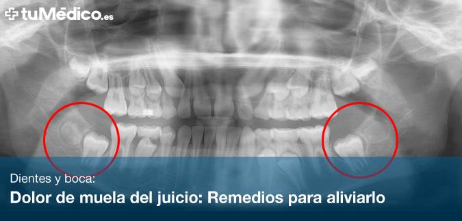 Dolor de muela del juicio: Remedios para aliviarlo