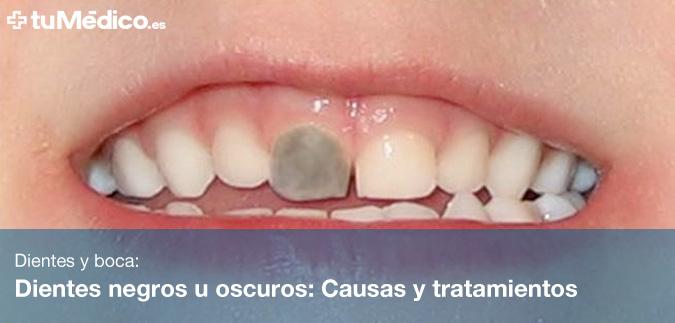 Dientes negros u oscuros: Causas y tratamientos