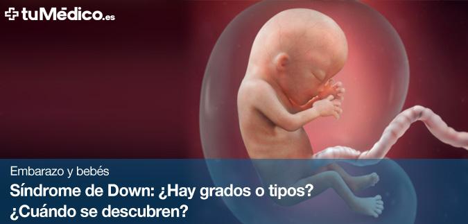 Sndrome de Down: Hay grados o tipos? Cundo se descubren?