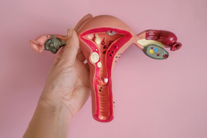 Miomas uterinos: qu� son, s�ntomas y c�mo se detectan