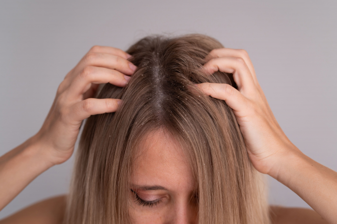 Caspa o dermatitis seborreica, por qu� no son lo mismo