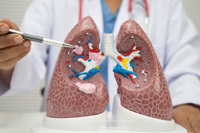 Qu� es un edema pulmonar y por qu� se acumula el l�quido