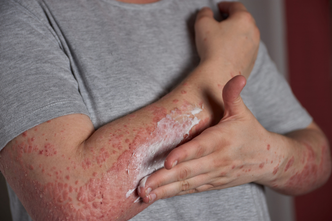 Erupci�n cut�nea, �alergia o infecci�n?