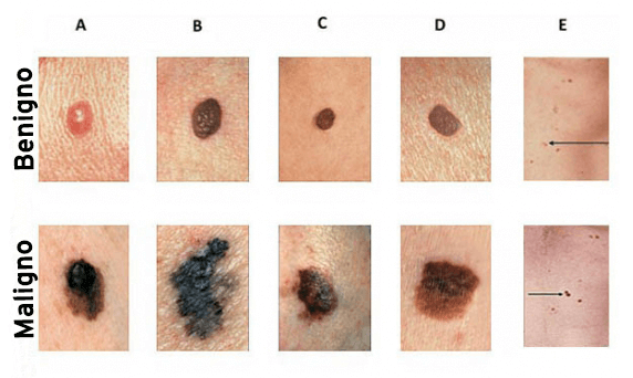 Resultado de imagen para Â¿Puede un lunar convertirse en un melanoma cancerÃ­geno?