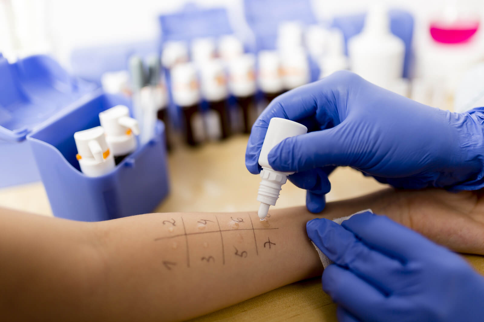 Allergy - skin prick tests